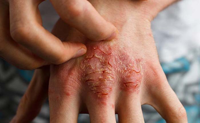 Bệnh eczema có ảnh hưởng tới đời sống hàng ngày của người bệnh không?
