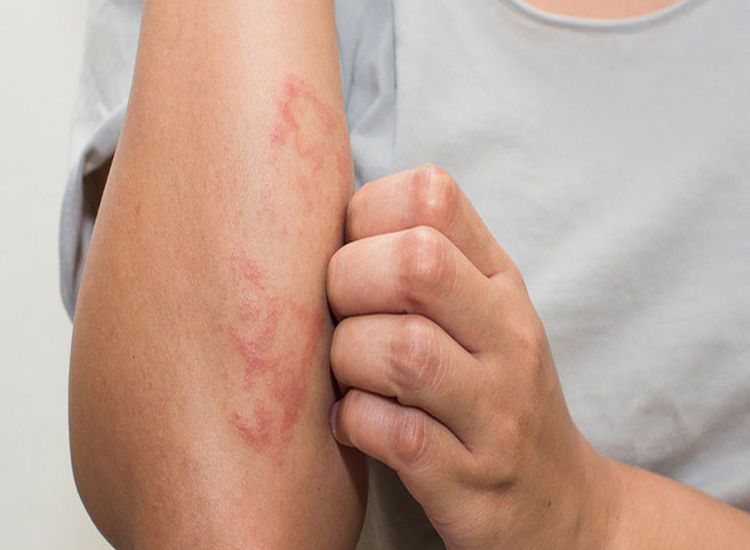 Bệnh eczema là bệnh gì - Dấu hiệu, nguyên nhân, cách chữa